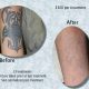 lazer-tattoo17